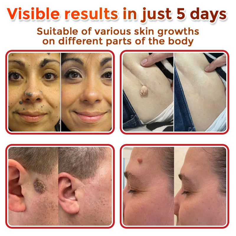 🔥🐨GFOUK® MicroNeedle Botanic Skin Tag Removal Patch ✅Australian Made