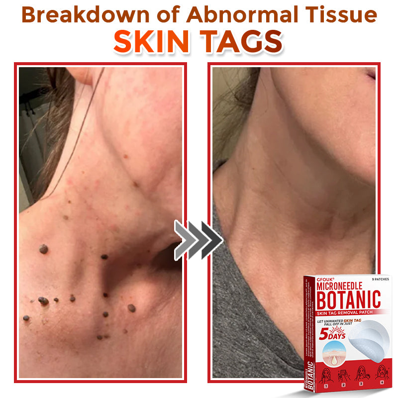 🔥🐨GFOUK® MicroNeedle Botanic Skin Tag Removal Patch ✅Australian Made