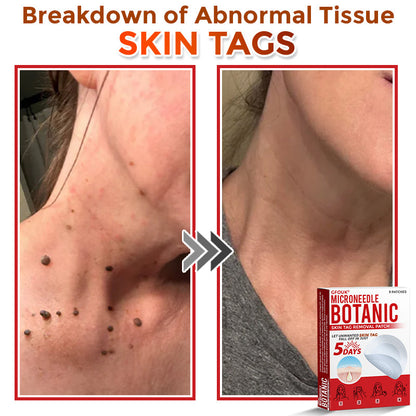 🔥🐨GFOUK® MicroNeedle Botanic Skin Tag Removal Patch ✅Australian Made