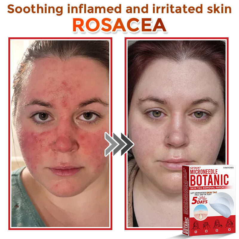 🔥🐨GFOUK® MicroNeedle Botanic Skin Tag Removal Patch ✅Australian Made