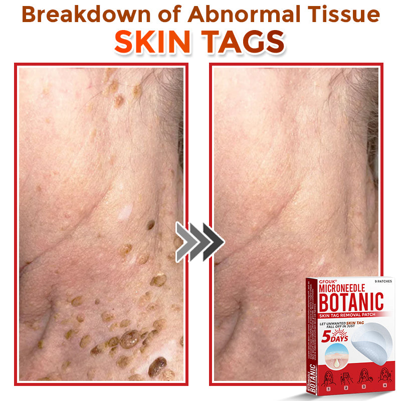 🔥🐨GFOUK® MicroNeedle Botanic Skin Tag Removal Patch ✅Australian Made