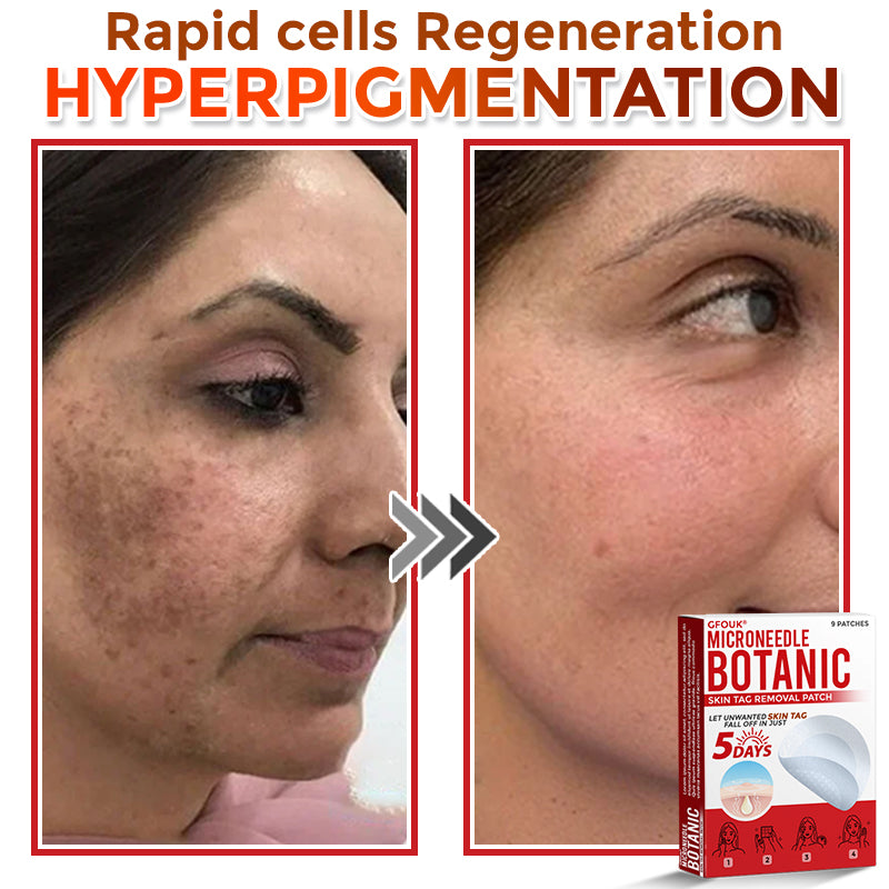 🔥🐨GFOUK® MicroNeedle Botanic Skin Tag Removal Patch ✅Australian Made