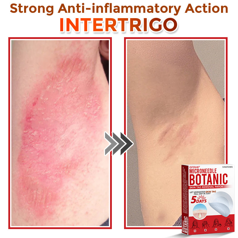 🔥🐨GFOUK® MicroNeedle Botanic Skin Tag Removal Patch ✅Australian Made