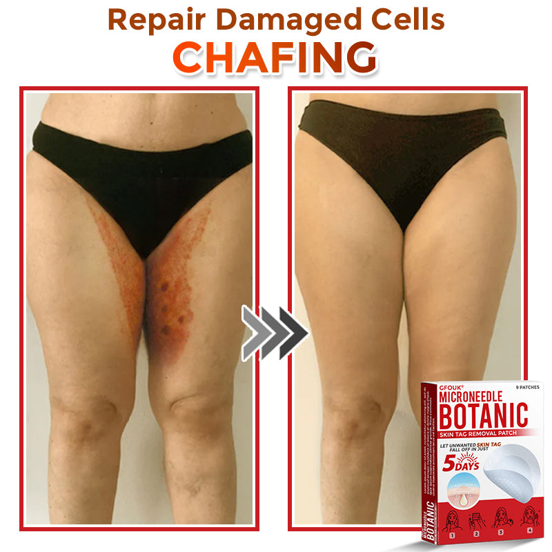 🔥🐨GFOUK® MicroNeedle Botanic Skin Tag Removal Patch ✅Australian Made