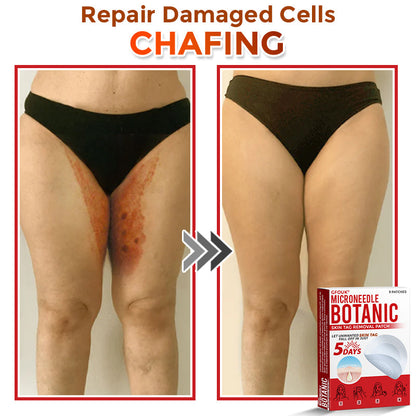 🔥🐨GFOUK® MicroNeedle Botanic Skin Tag Removal Patch ✅Australian Made