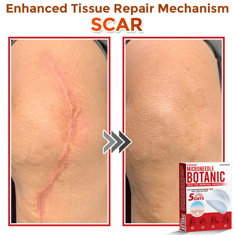 🔥🐨GFOUK® MicroNeedle Botanic Skin Tag Removal Patch ✅Australian Made